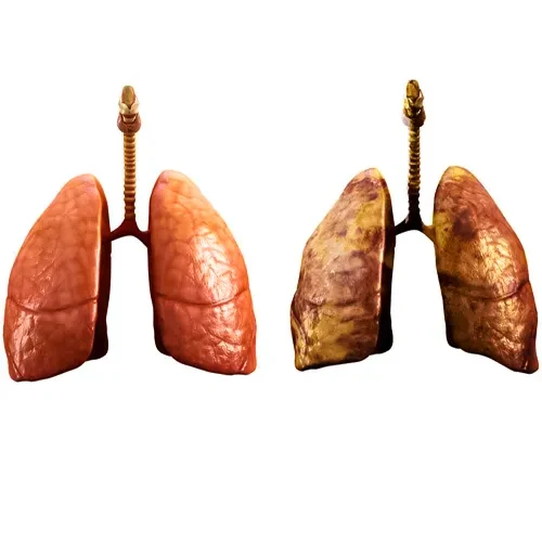 کاهش خطر بروز سرطان ریه با ترک سیگار