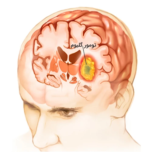 استفاده از کارموستین ویفر در درمان تومور های مغزی