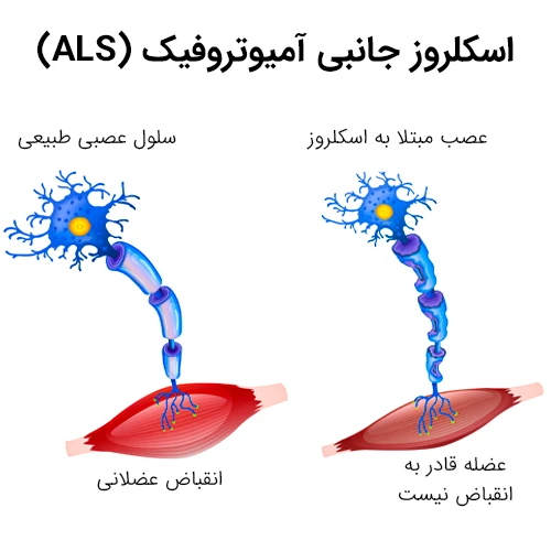 کنترل بیماری اسکلروز جانبی آمیوتروفیک با داروی اداراوون