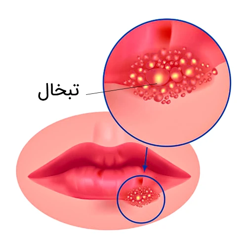 موارد احتیاطی مصرف داروی گوسلکوماب