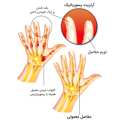 درمان آرتریت پسوریاتیک با داروی گوسلکوماب