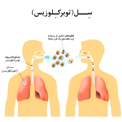 پیشگیری از ابتلا به بیماری سل با تزریق واکسن ب ث ژ