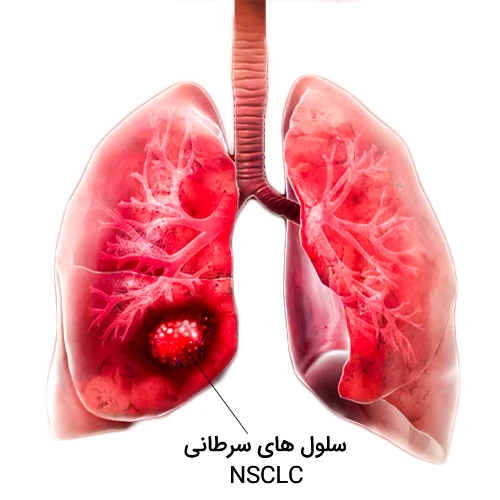 درمان نوعی سرطان سلول های غیر کوچک ریه با داروی آمیوانتاب