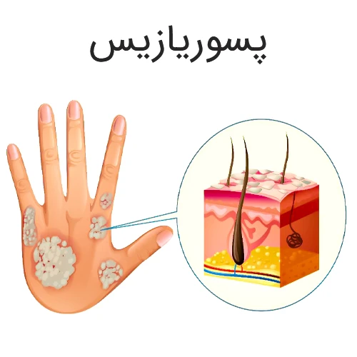 درمان بیماری پسوریازیس با داروی تیلدراکیزوماب