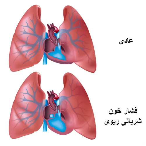 کنترل فشار خون ریوی با مصرف داروی ترپروستینیل