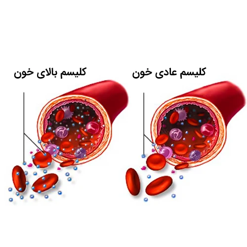 داروی زومتا در درمان سطح بالای کلسیم خون