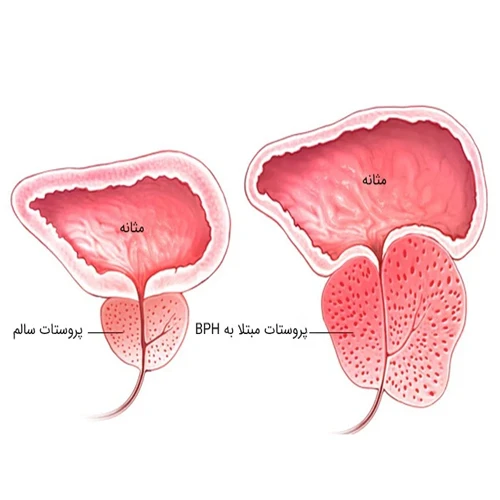 هایپرپلازی خوش خیم پروستات (BPH)