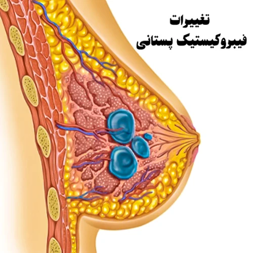 تغییرات فیبروکیستیک پستان