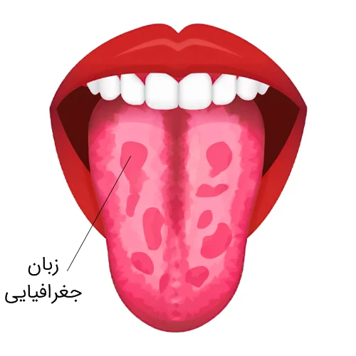 بیماری زبان جغرافیایی