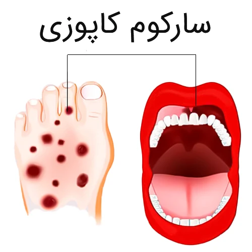 سارکوم کاپوزی