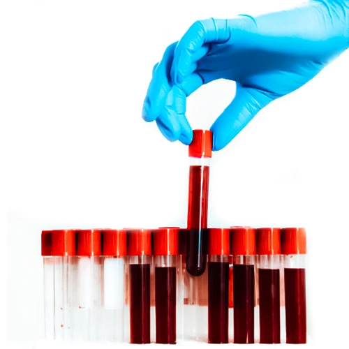 آزمایش خون از راه های تشخیص بیماری پمفیگوس