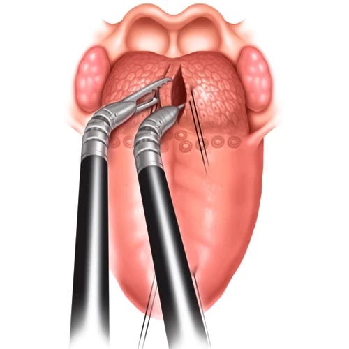 جراحی از روش های درمان سرطان زبان