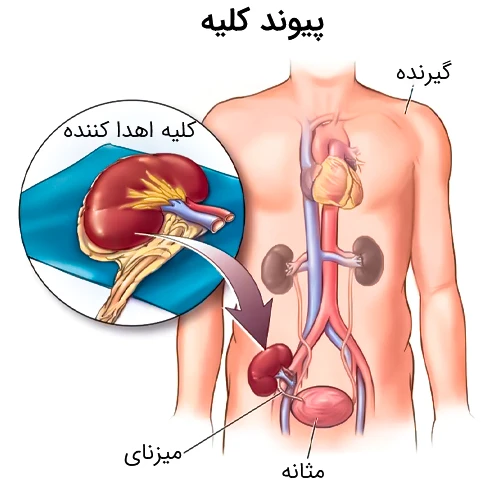 داروی باسیلیکسیماب مورد استفاده پس از پیوند کلیه