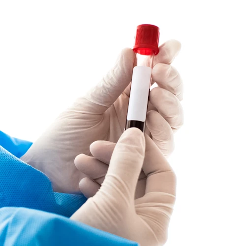آزمایش خون از روش های تشخیص بیماری سیاه زخم