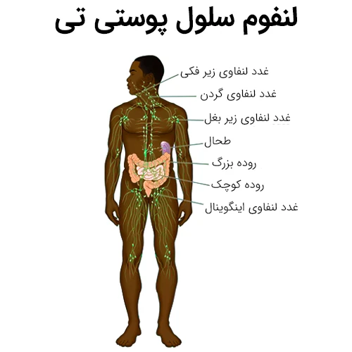 درمان لنفوم سلول پوستی تی با داروی متوکسالن