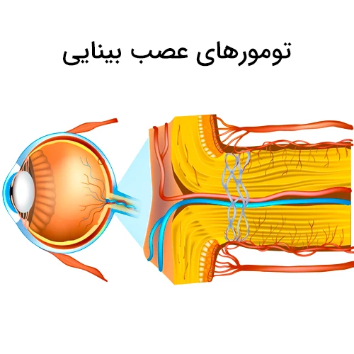 خطر آسیب به عصب بینایی طی درمان بیماری مننژیوم