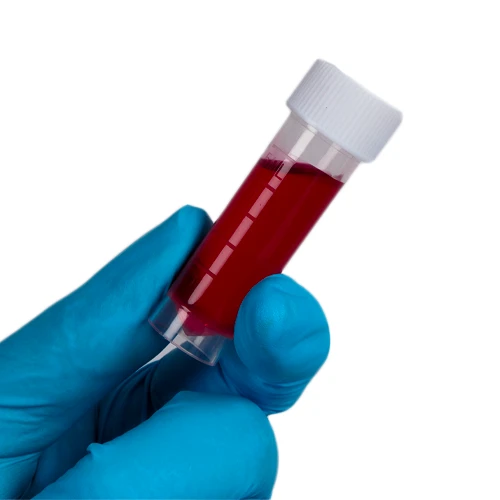 آزمایش خون از راه های تشخیص کولیت اولسراتیو