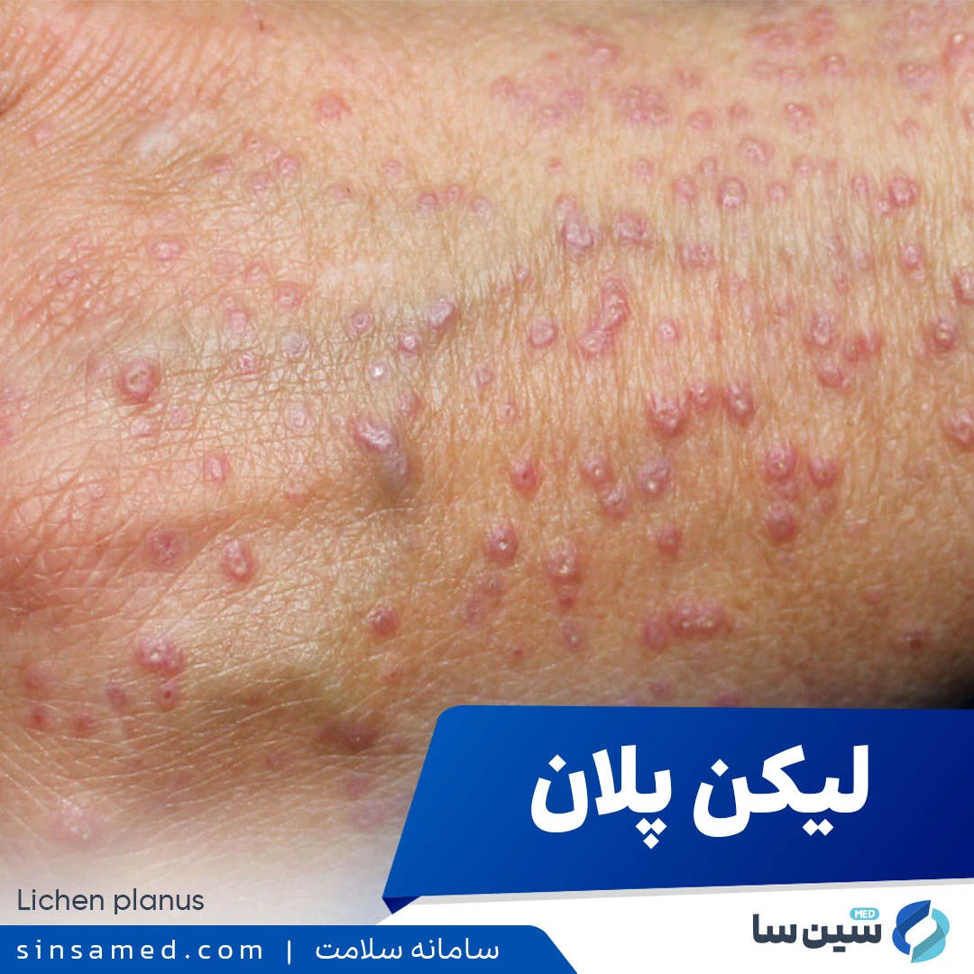 بیماری لیکن پلان