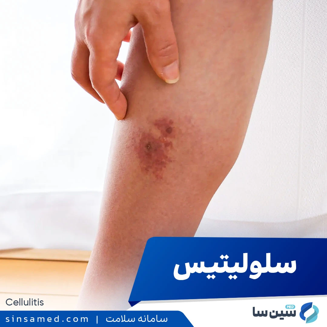 سلولیتیس (التهاب بافت) چیست؟