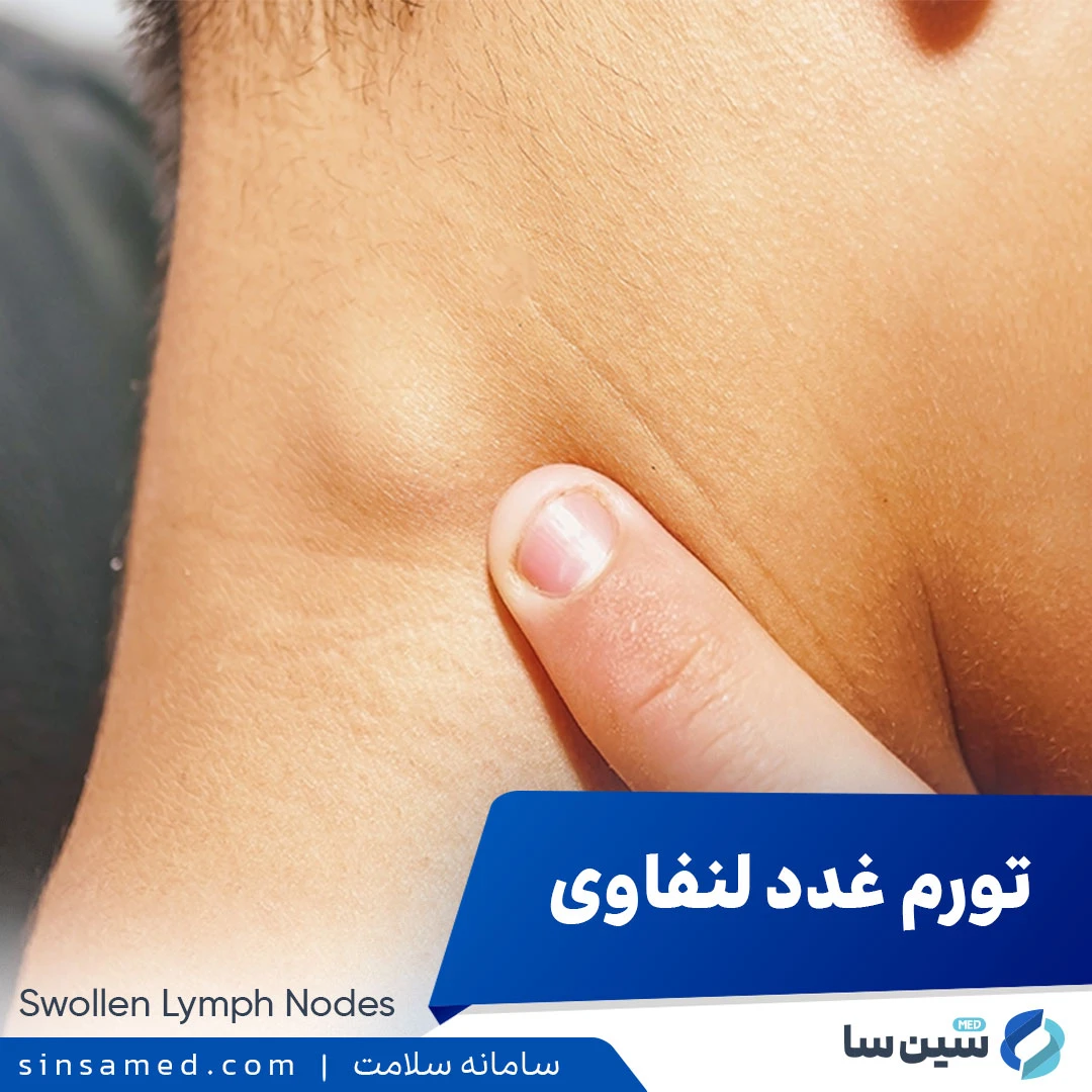 تورم غدد لنفاوی چیست؟