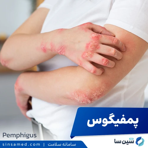 بیماری پمفیگوس | علل بروز،نشانه ها، روش تشخیص و درمان آن