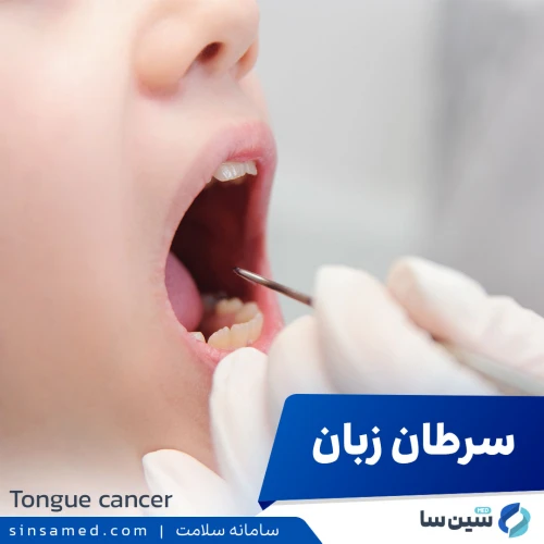 سرطان زبان | علل بروز، نشانه ها، روش تشخیص و درمان آن