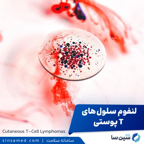 لنفوم سلول های T پوستی | علل بروز، نشانه ها، تشخیص و درمان