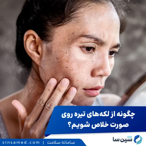 چگونه از لکه‌های تیره روی صورت خلاص شویم؟