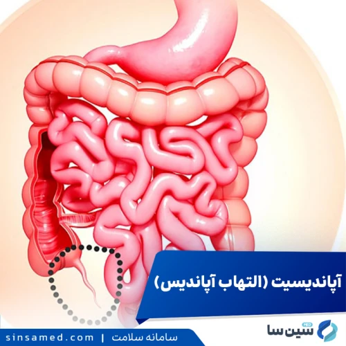 آپاندیسیت-التهاب آپاندیس | علل بروز، نشانه ها، تشخیص، درمان