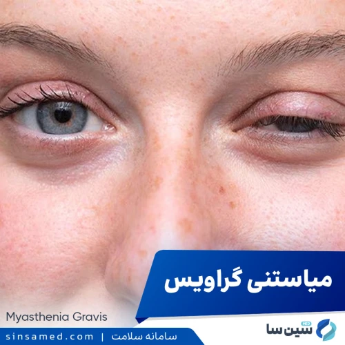 میاستنی گراویس | علل بروز، نشانه ها، روش تشخیص و درمان