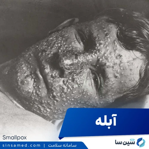 بیماری آبله | علل بروز، نشانه ها، روش تشخیص و درمان