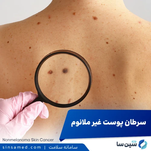 سرطان پوست غیر ملانوم | علل بروز، نشانه ها، تشخیص و درمان
