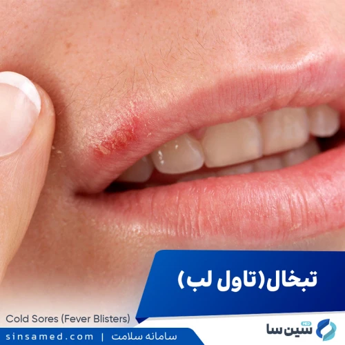 تبخال (تاول لب) | علل بروز، نشانه ها، روش تشخیص و درمان