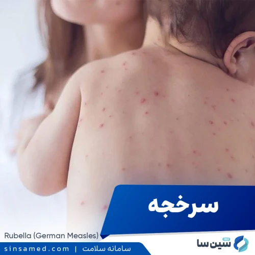 سرخجه (سرخک آلمانی) | علل بروز، نشانه ها، تشخیص و درمان