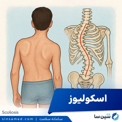 اسکولیوز | علل بروز، نشانه ها، روش تشخیص و درمان