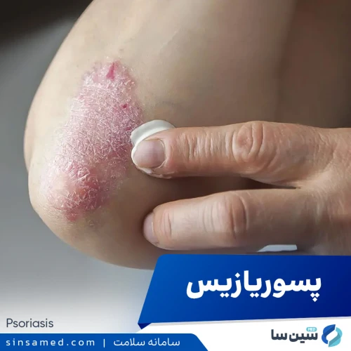 پسوریازیس | علل بروز، نشانه ها، روش تشخیص و درمان