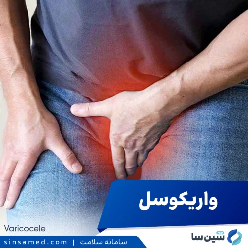 واریکوسل | علل بروز، نشانه ها، روش تشخیص و درمان