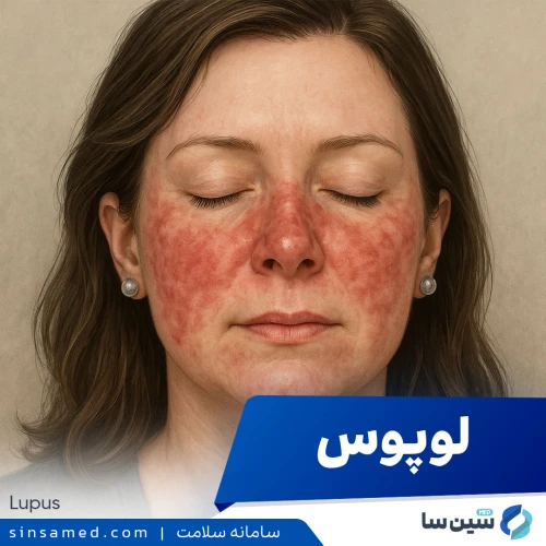 لوپوس | علل بروز، نشانه ها، روش تشخیص و درمان