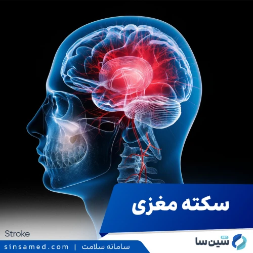 سکته مغزی | علل بروز، نشانه ها، روش تشخیص و درمان