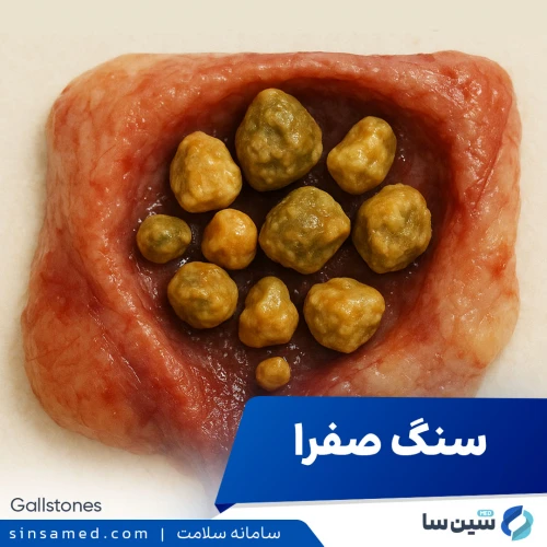 سنگ صفرا | علل بروز، نشانه ها، روش تشخیص و درمان