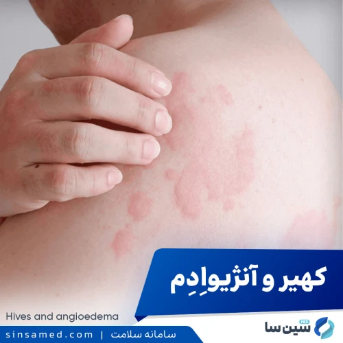 کهیر و آنژیواِدِم | علل بروز، نشانه ها، روش تشخیص و درمان