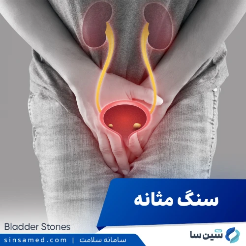 سنگ مثانه | علل بروز، نشانه ها، روش تشخیص و درمان