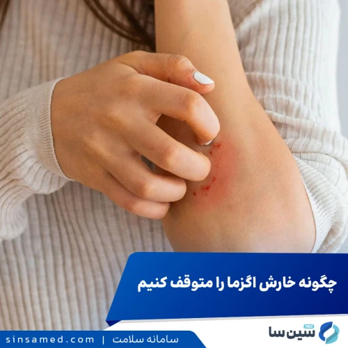 چگونه از خارش ناشی از اگزما خلاص شویم؟