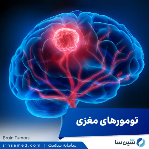 تومورهای مغزی | علل بروز، نشانه ها، روش تشخیص و درمان