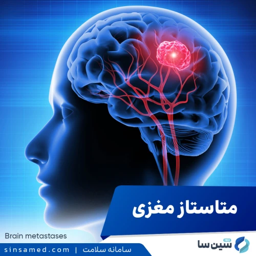 متاستاز مغزی | علل بروز، نشانه ها، روش تشخیص و درمان