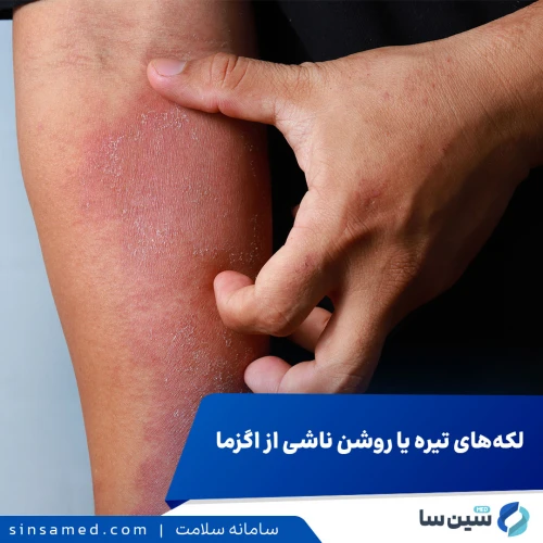 لکه‌های تیره یا روشن ناشی از اگزما و نحوه مدیریت آن ها