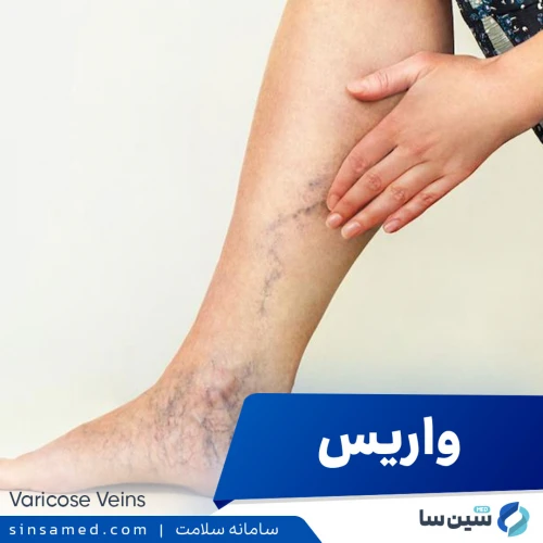 واریس (رگ های واریسی) | علل بروز، نشانه ها، تشخیص و درمان
