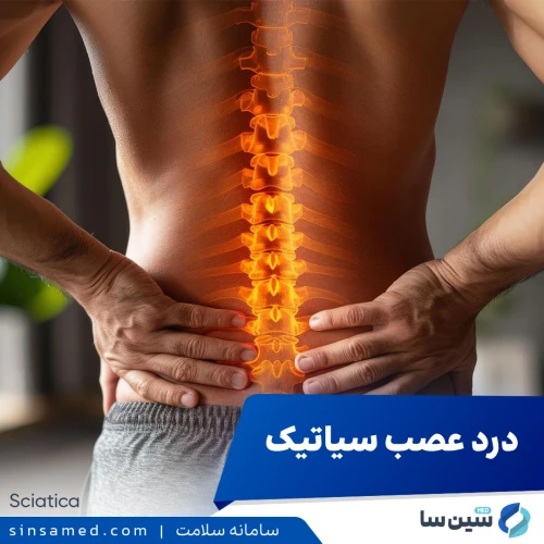 درد عصب سیاتیک | علل بروز، نشانه ها، روش تشخیص و درمان