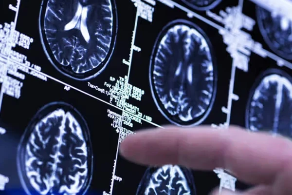 MRI و پیش‌بینی سرعت پیری بدن | آیا مغز شما زودتر از سن‌تان پیر می‌شود؟