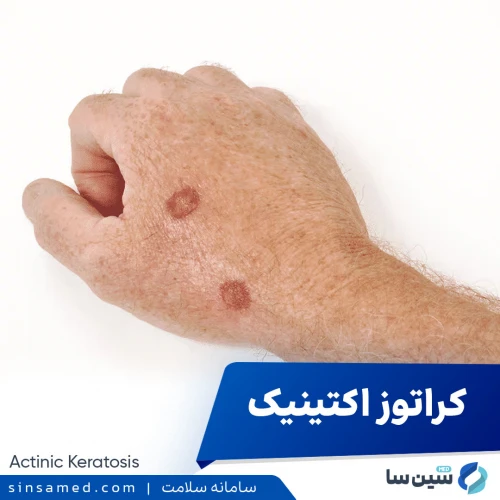 کراتوز آکتینیک (AK) | علل بروز، نشانه ها، تشخیص و درمان